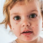 Chickenpox vaccine: age, benefits, and risks