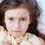 How to avoid getting chickenpox