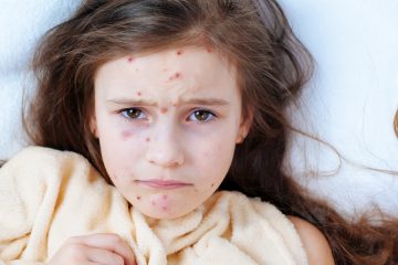 How to avoid getting chickenpox