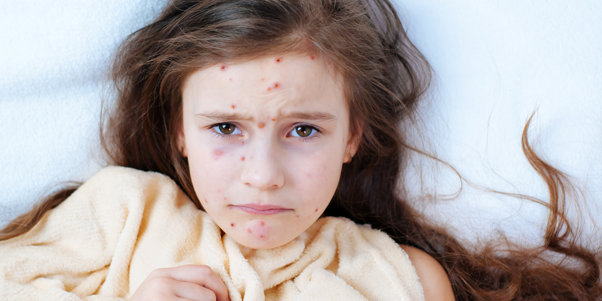 How_To_Avoid_Getting_Chickenpox