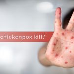 how does chickenpox kill