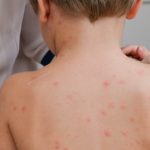 How to prevent chickenpox