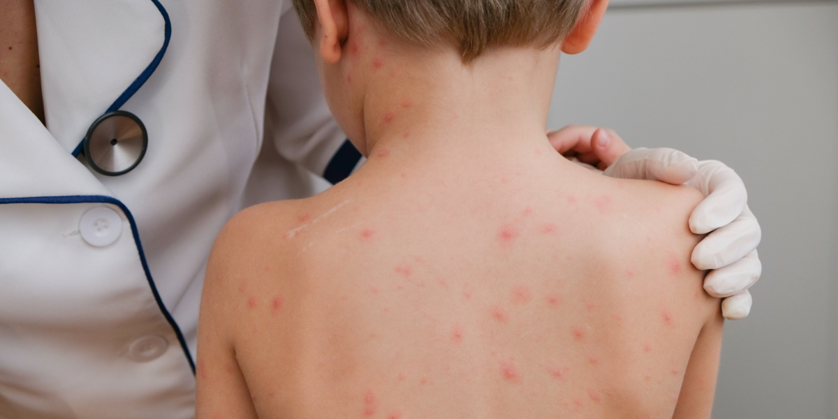 How_to_prevent_Chickenpox