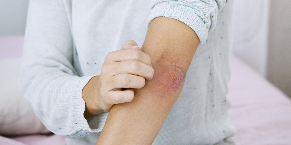 How_to_protect_yourself_from_Shingles