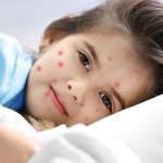 Myths and facts about chickenpox