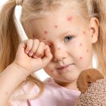 recognizing the signs and symptoms of chickenpox
