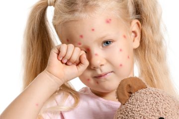 recognizing the signs and symptoms of chickenpox