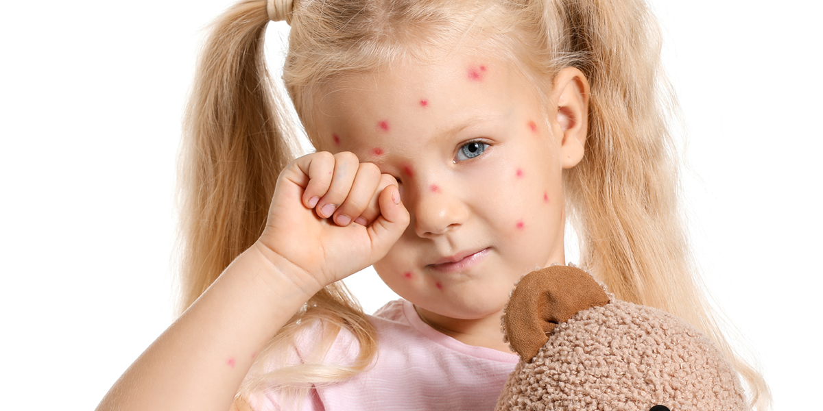 The_Signs_and_Symptoms_of_Chickenpox