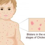 What-are-the-stages-of-Chickenpox