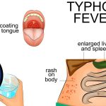 What is typhoid fever and how to treat it effectively