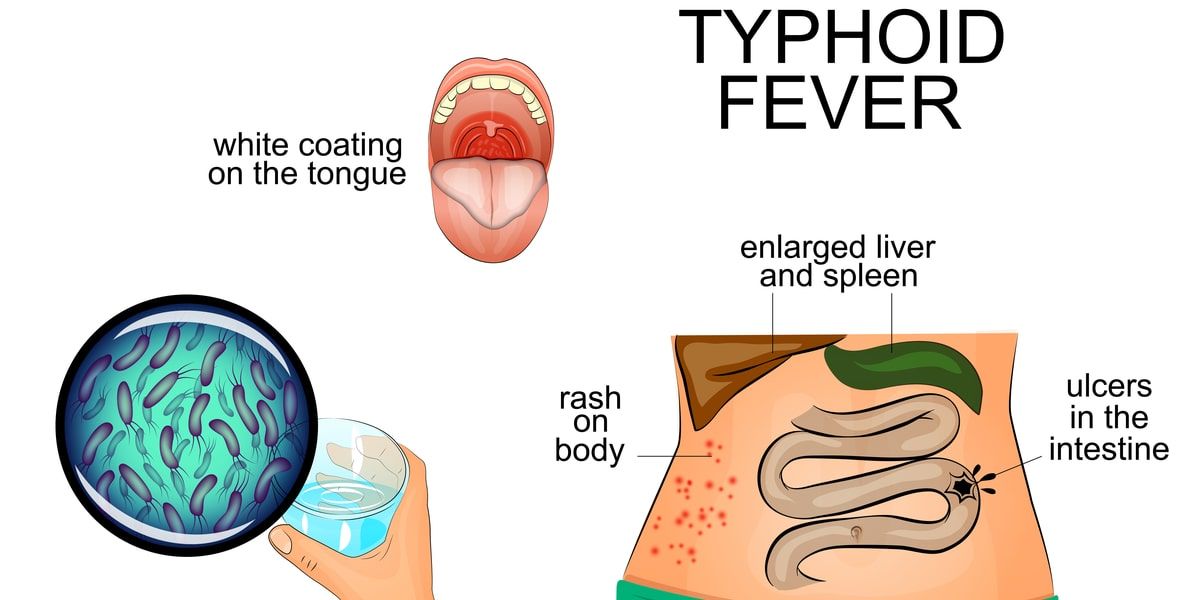 What is Typhoid fever and how do you treat it