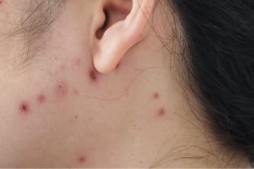 Vaccination Chickenpox