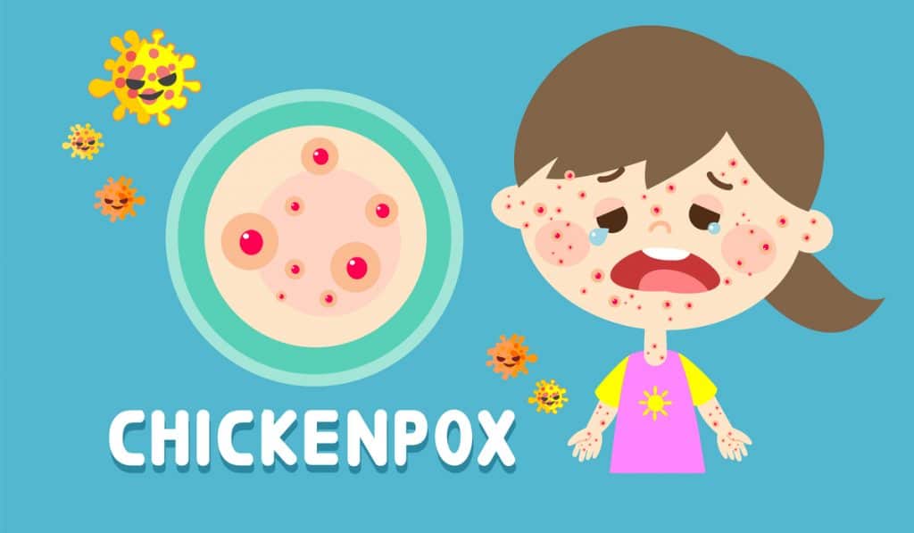 Chickenpox Vaccination - Touchwood Pharmacy