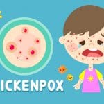 Child with chickenpox