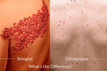 Shingles vs. Chickenpox What’s the Difference