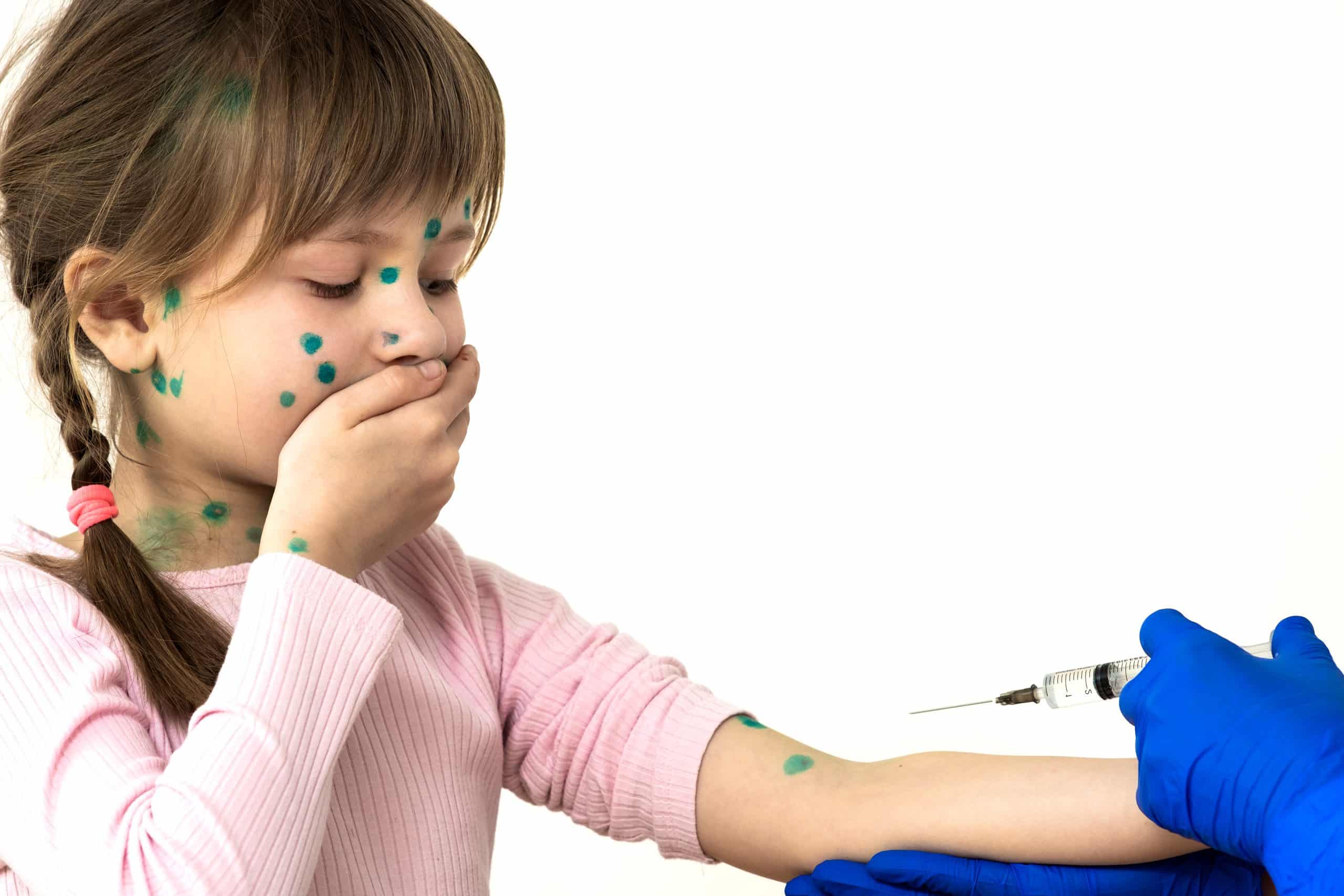 chickenpox vaccination