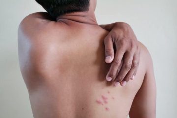 Shingles without prior chickenpox?