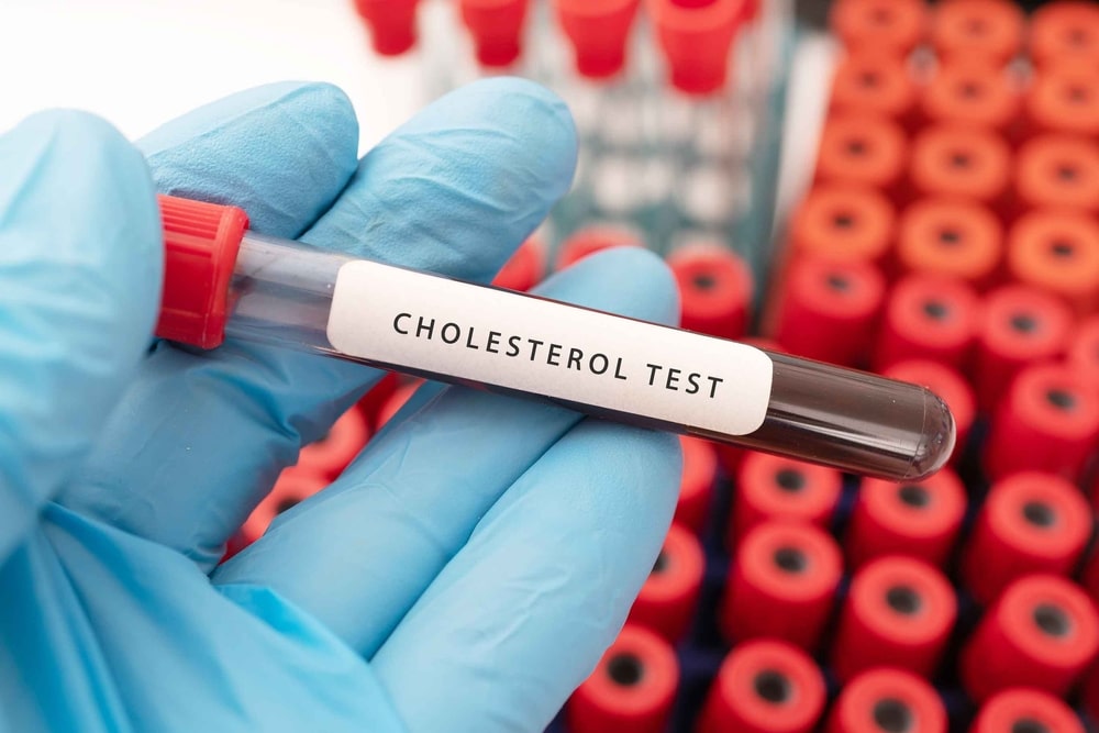 Cholesterol Blood Tests – Do we need to get them regularly?