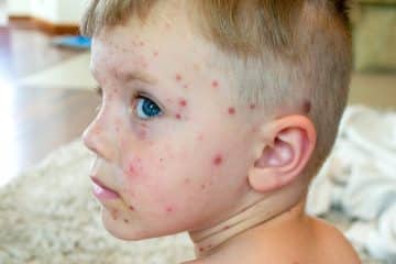 chickenpox vaccination in Streatham