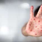 Chickenpox Vaccination in Northolt