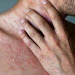 Prevent shingles with adult chickenpox vaccination