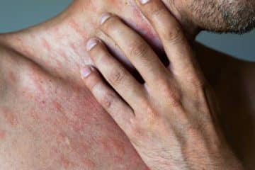 Prevent shingles with adult chickenpox vaccination