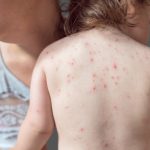 Navigating chickenpox vaccine benefits and drawbacks