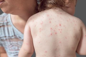 Navigating chickenpox vaccine benefits and drawbacks