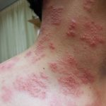 Explaining the link between shingles and chickenpox