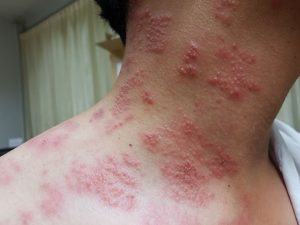 Explaining the link between shingles and chickenpox