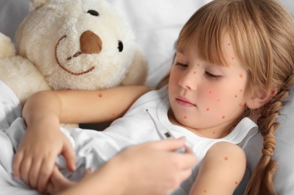 Explore chickenpox insights and expectations