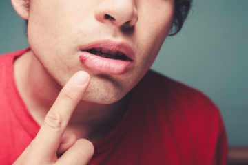 An individual with a red shirt pointing to his mouth potentially signaling impetigo infection
