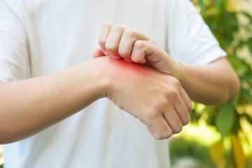 A man's wrist with a red rash possibly from infected insect bites
