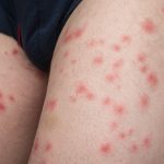 Effectively managing symptoms from infected insect bites