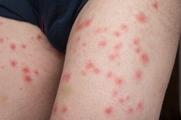 Effectively managing symptoms from infected insect bites