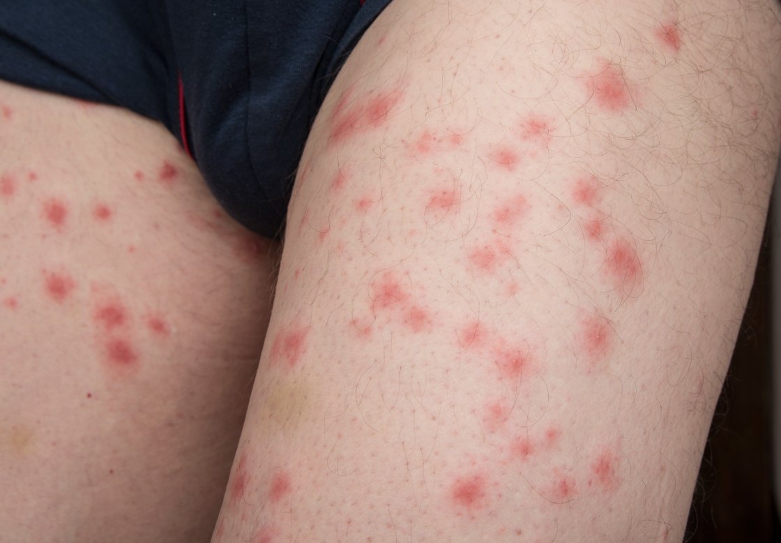Effectively-managing-symptoms-from-infected-insect-bites