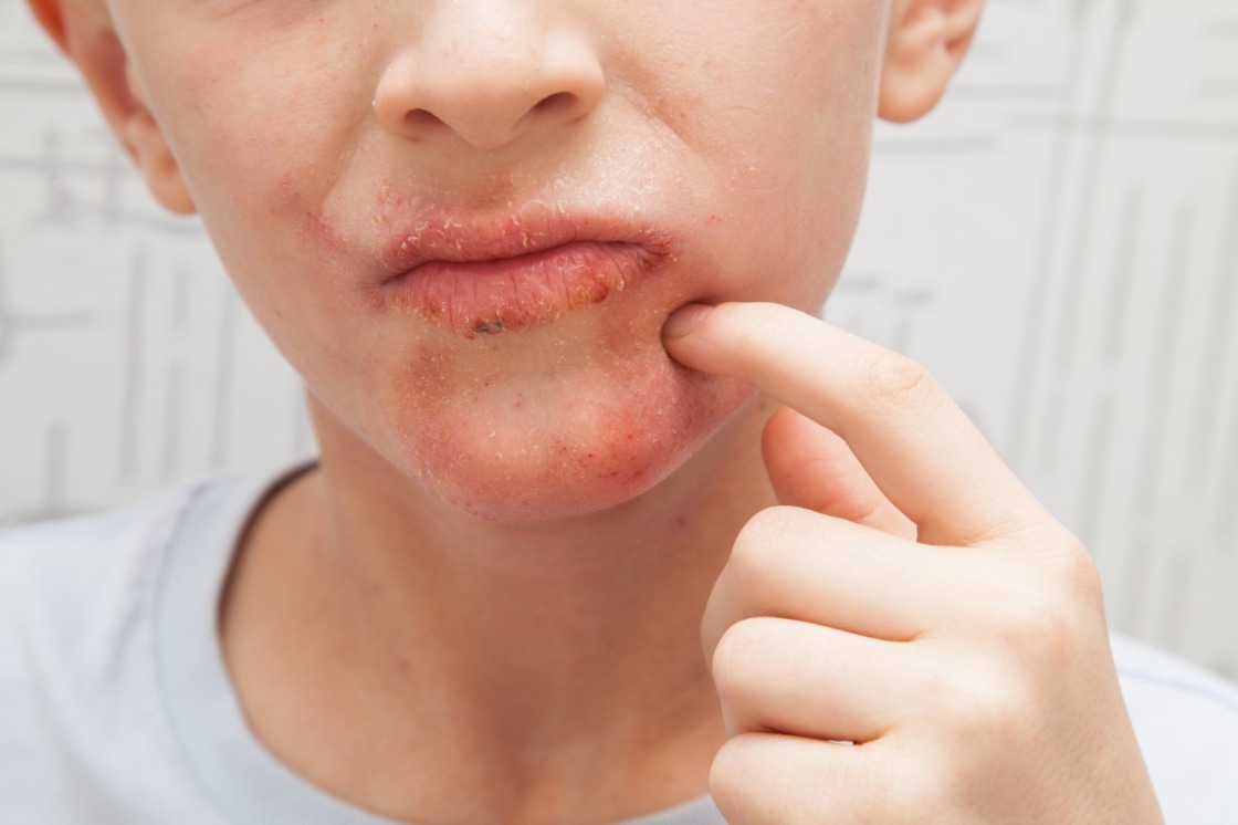 Identification-and-effective-treatment-of-impetigo-in-children