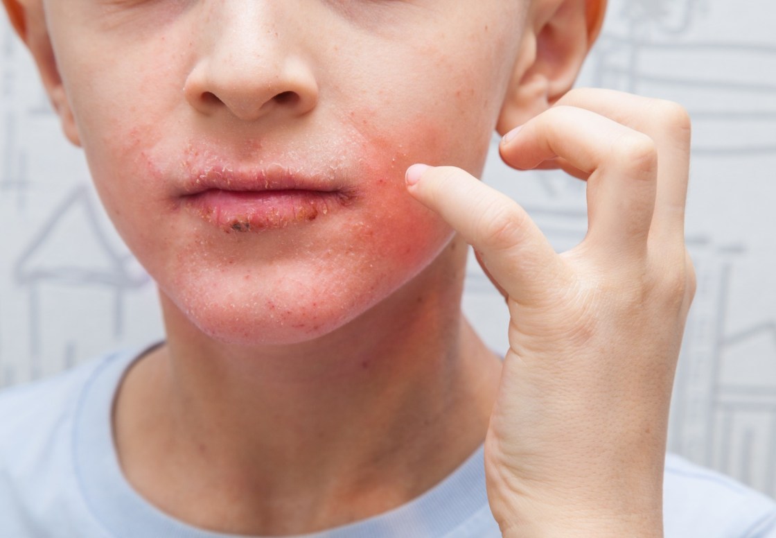 Early-warning-signs-of-impetigo