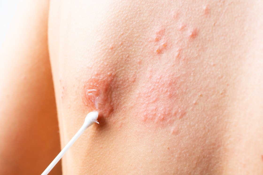 Effective-methods-for-managing-shingles