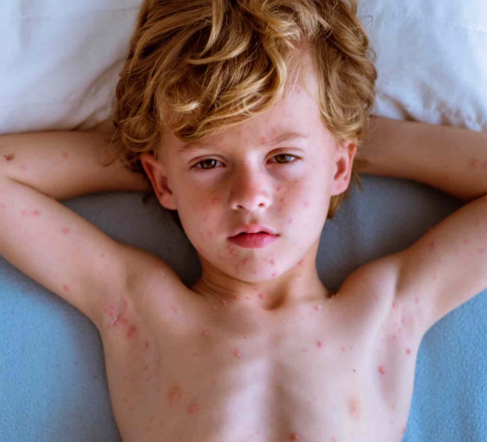 risk-of-shingles-without-previous-chickenpox-infection