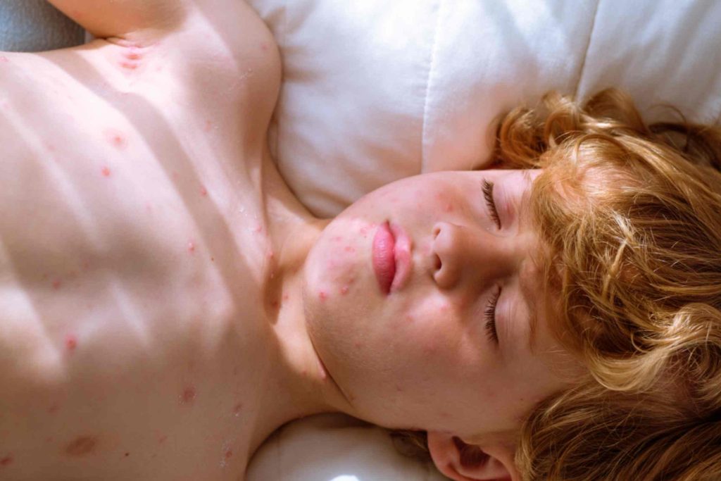 Bathing tips for chickenpox relief