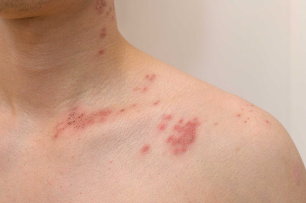 First signs of shingles and vaccine benefits