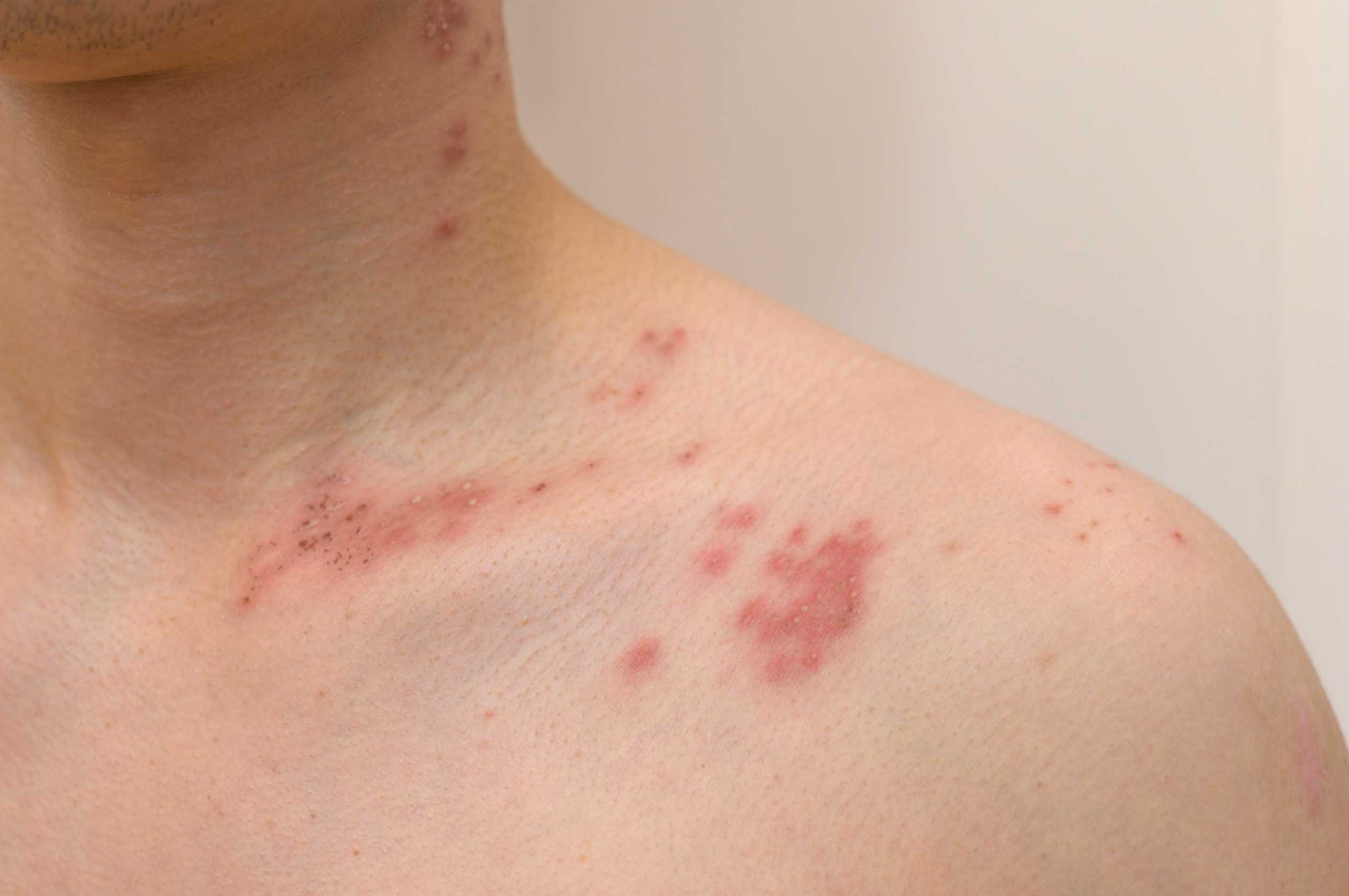 First-signs-of-shingles-and-vaccine-benefits