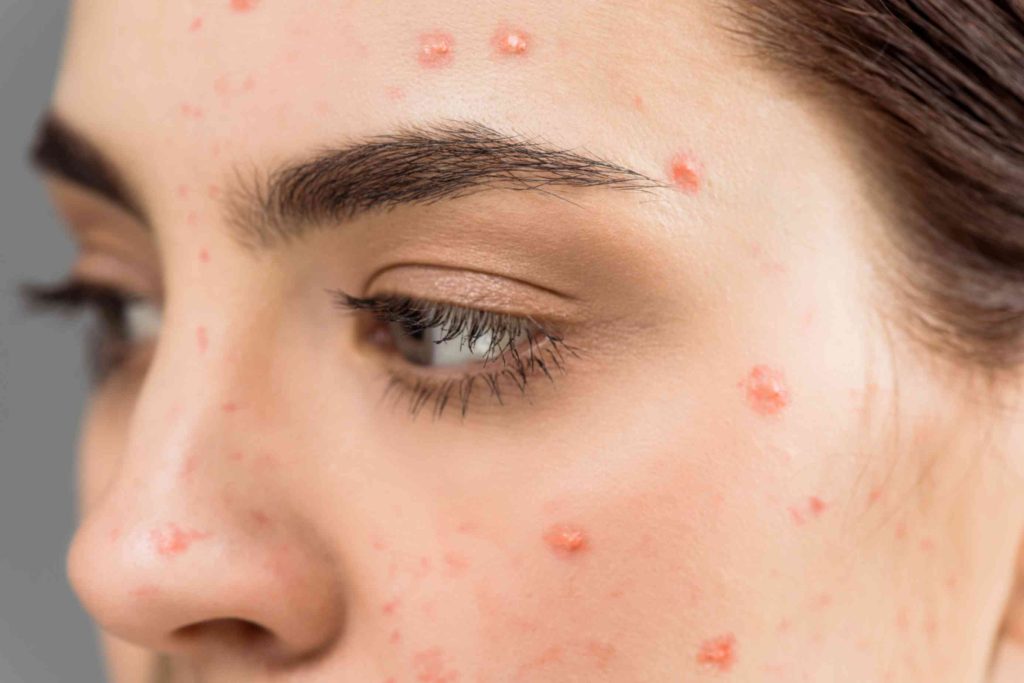 can pregnant women get chickenpox and is it dangerous