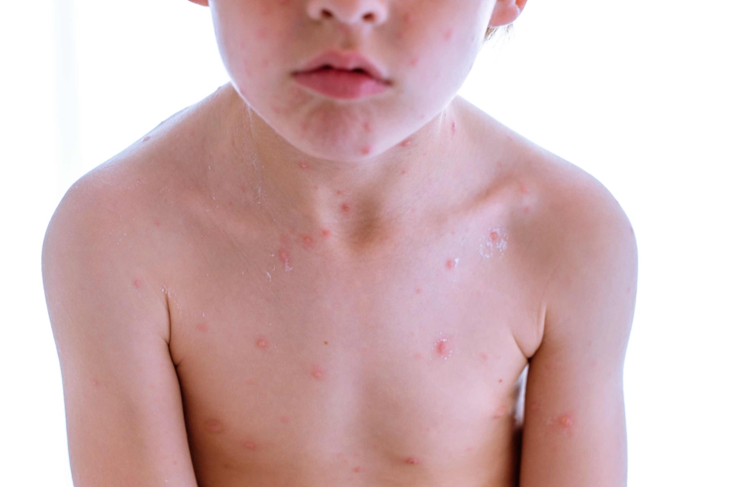 Managing-chickenpox-in-children