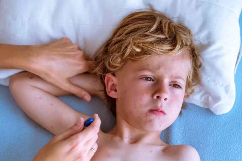 child with chickenpox rash receiving care and treatment