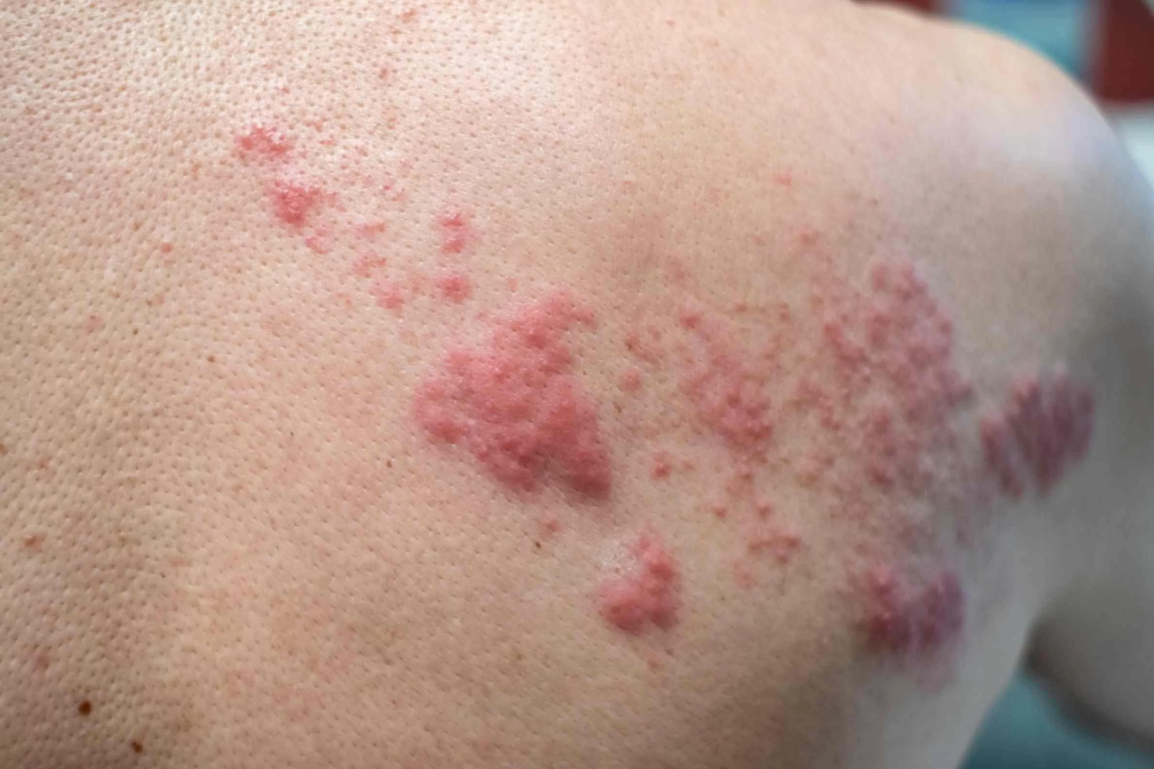 -Understanding-the-chances-of-shingles-coming-back-after-first-infection