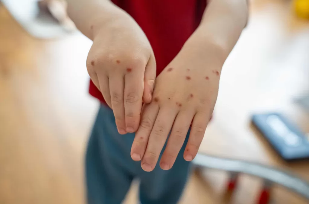 duration of immunity after chickenpox vaccination