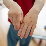 duration of immunity after chickenpox vaccination