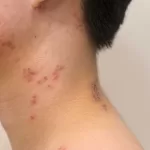 shingles rash with red blisters on skin